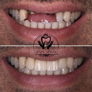 تصویر آموزشی از پایه تیتانیومی ایمپلنت دندان درون فک و روکش دندان