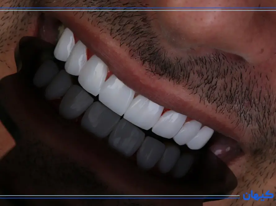 لمینت دندان چگونه انجام می‌شود؟